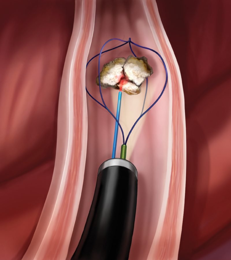 chirurgie_rein chirurgie_rein