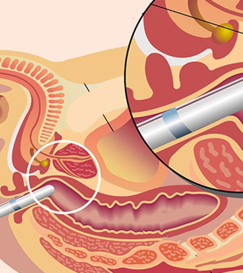 img_biopsie-prostate (1) img_biopsie-prostate (1)